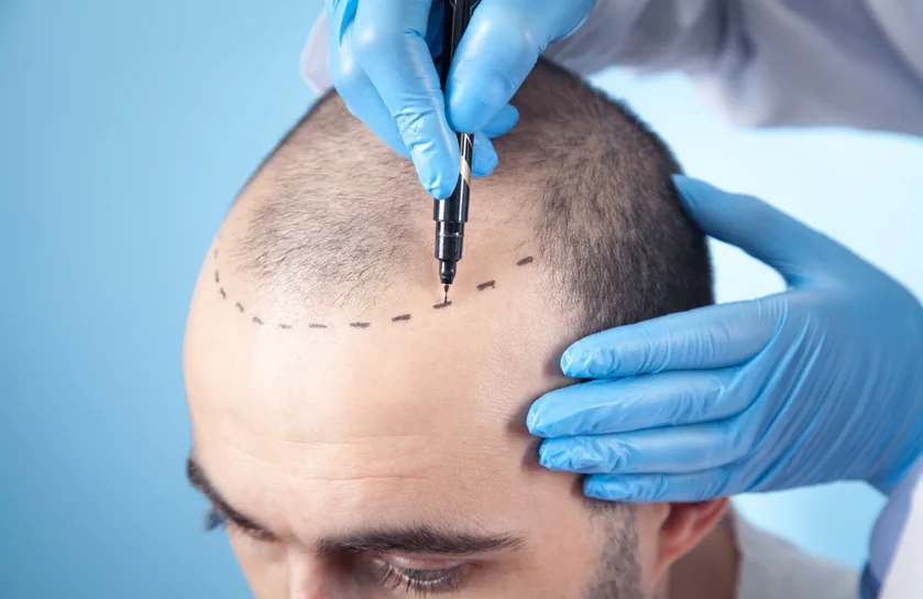 Regrow Your Confidence with Advanced Hair Transplant Techniques at Hope Clinic, Surat