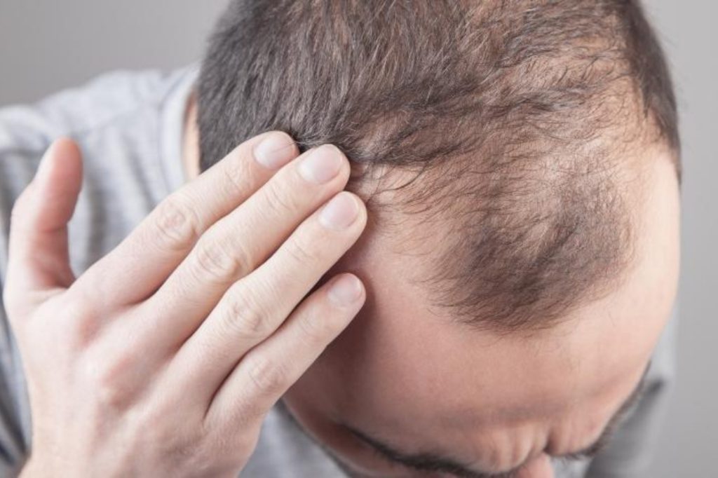 How to reduce Hairfall for men and women: cause remedies and best treatments