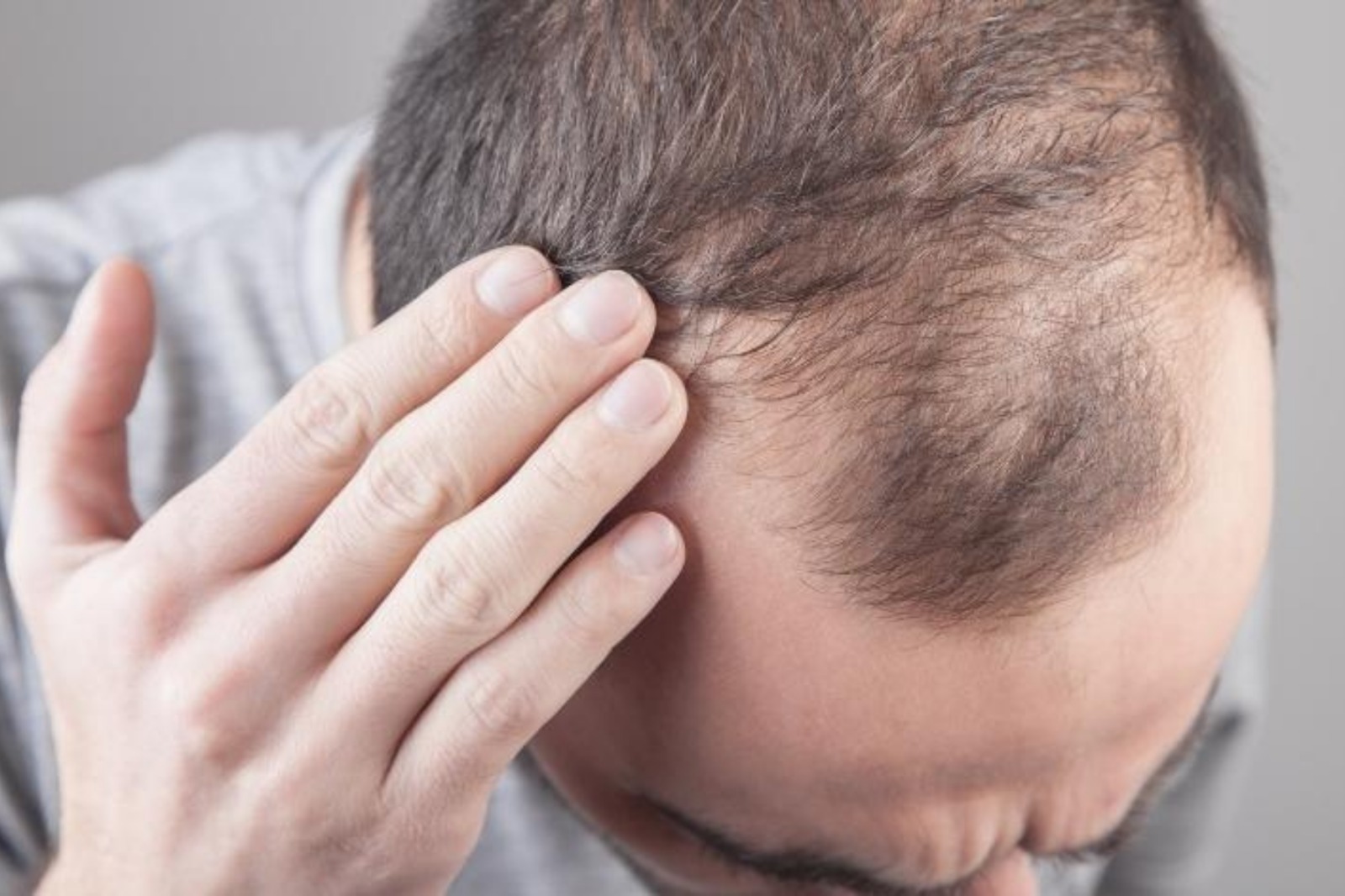 How to reduce Hairfall for men and women: cause remedies and best treatments