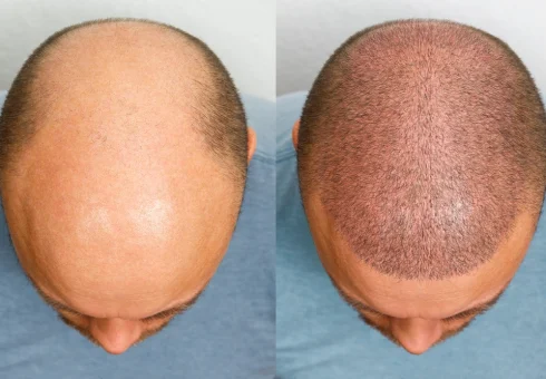-hair-transplant